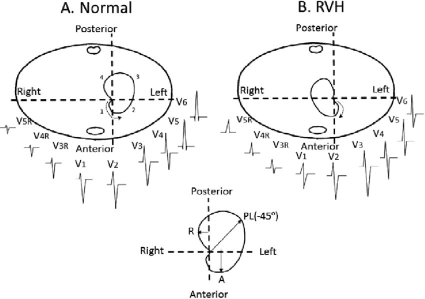 850x598 Upper Typical Horizontal Plane Loop Of The Vectorcardiography