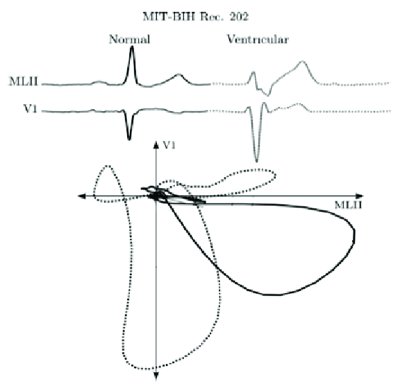 586x563 Vectorcardiogram Plot Of Ecg Signals From Two Leads Continuous