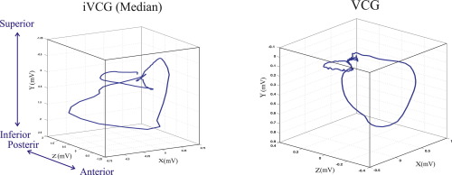 500x194 Construction Of Intracardiac Vectorcardiogram From Implantable