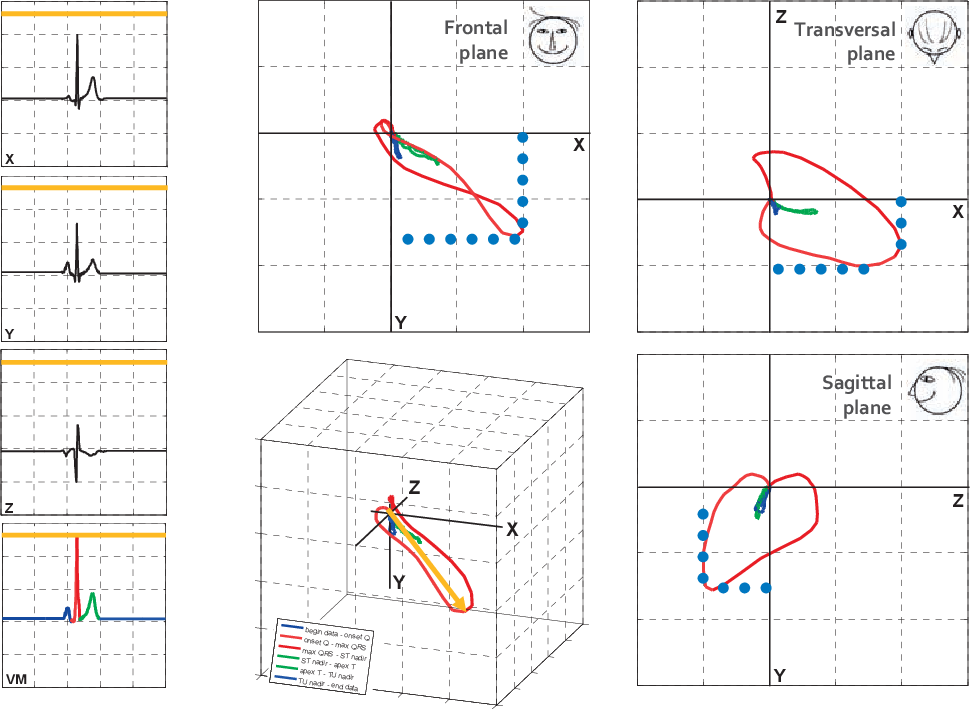 970x710 Figure From Vectorcardiographic Diagnostic Prognostic