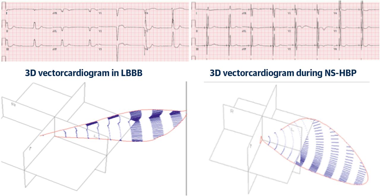 1280x662 Figure His Bundle Pacing Jacc Journal Of The American