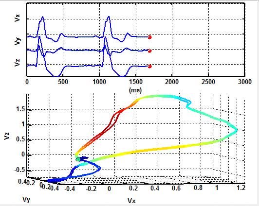 532x424 Filespatiotemporal Representation Of Cardiac Vectorcardiogram