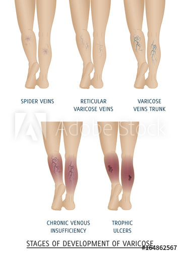 357x500 Types Of Varicose Veins In Women Stages Of Development
