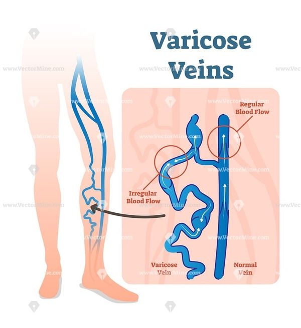 600x655 Varicose Veins Blood Flow Vector Illustration Diagram Health