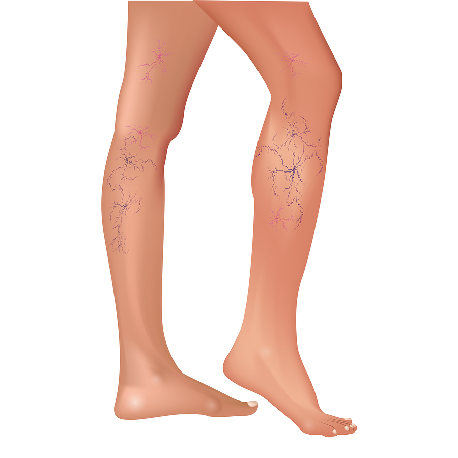 900x900 Varicose Veins In The Legs Vascular Or Spider Veins Vector