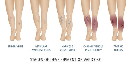 450x225 Vector Illustration Of A Varicose Illness Of Veins Of The Legs