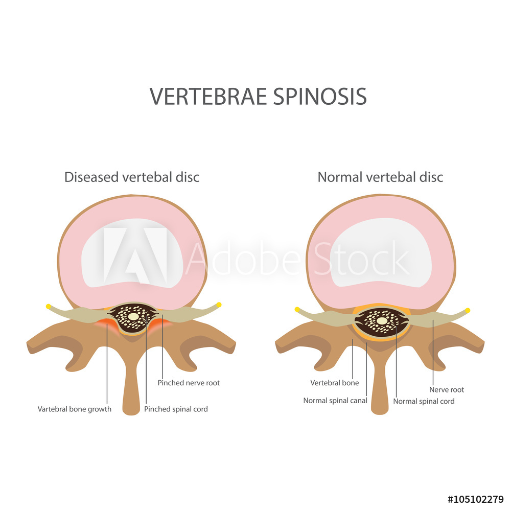 1000x1000 Photo Art Print Back Pain Spin Stenosis Vertebrae Disease