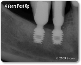275x220 Bicon Dental Implants Short Implants Avoid Vital Structures