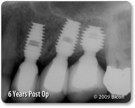 275x220 Bicon Dental Implants Rontis Medical