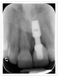 190x252 Bicon Dental Implants