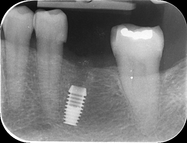 624x478 Bicon Molar Implant Placement Too Deep To Restore