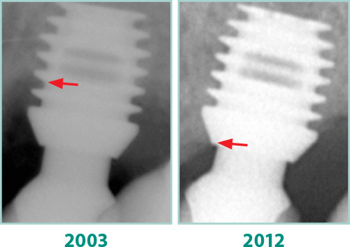 500x353 Bone Gain And Bicon Dental Implants