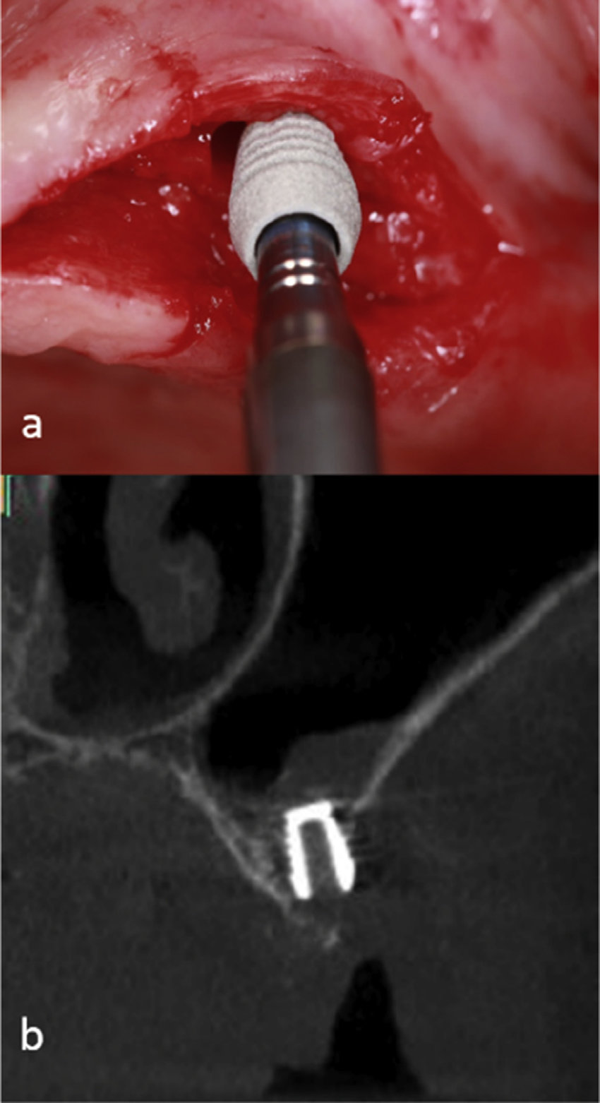 850x1562 Clinical Image Of The Insertion Of The Bicon Implant After