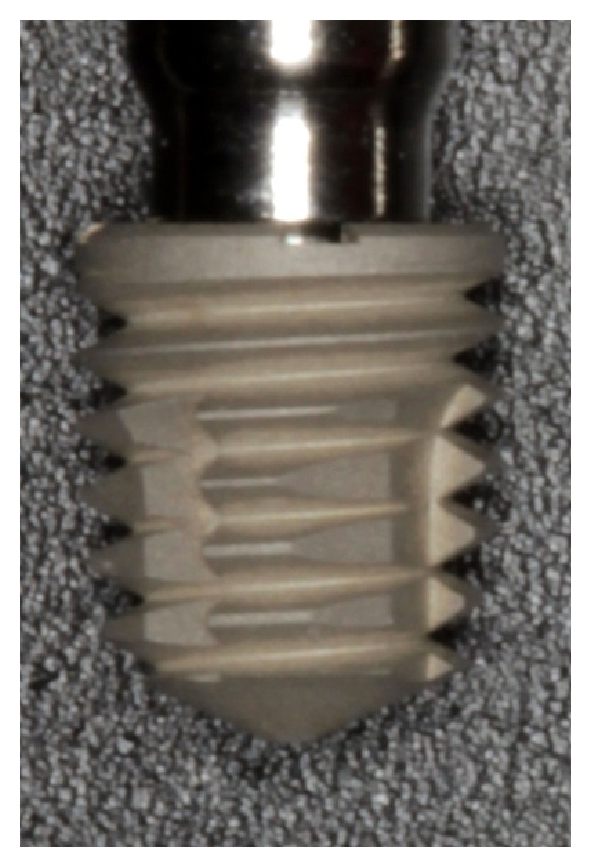 591x867 Implants And Prosthetic Crowns Used In The Study