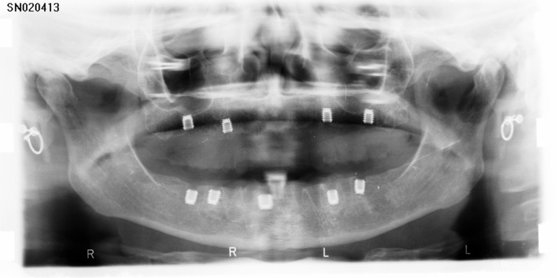 800x400 Maxillary And Mandibular Metal Free Prostheses On Bicon