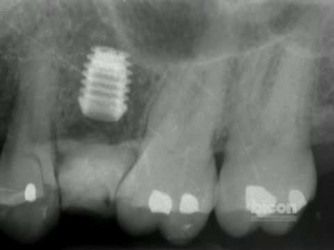 480x360 The Bicon Short Implant Surgical Technique