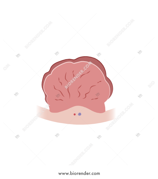 550x620 Biorender Colon Cancer