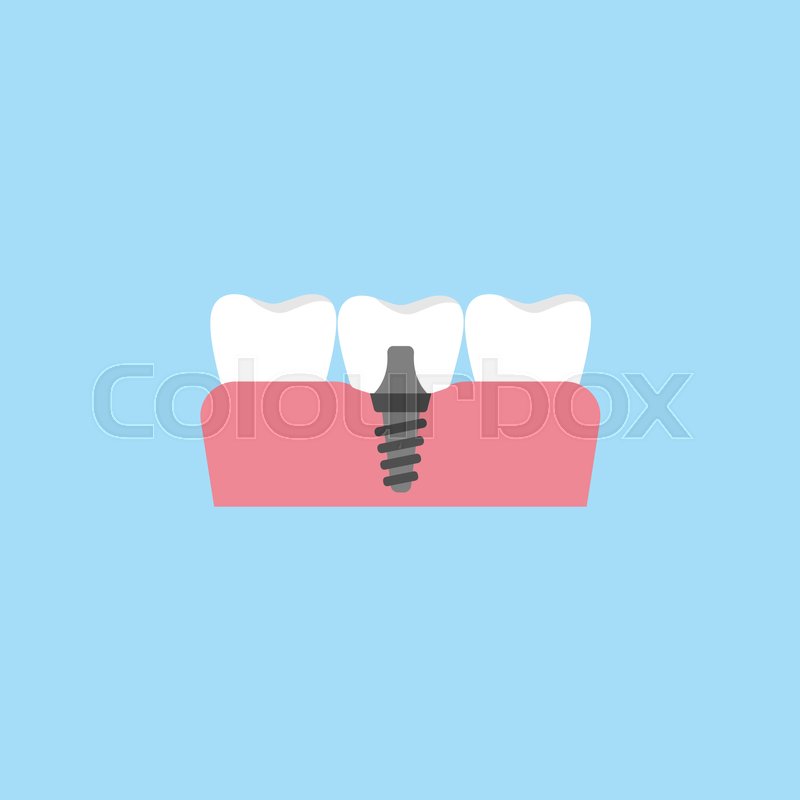 800x800 Dental Implant Flat Icon, Dental And Stock Vector Colourbox