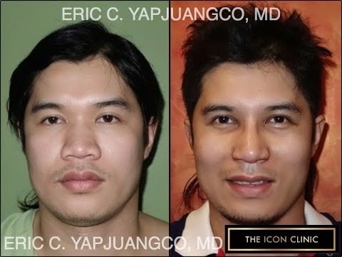 Asian Rhinoplasty 480x360 Asian Rhinoplasty