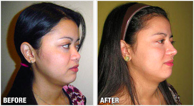 Icon Clinic Plastic Surgery Philippines Rhinoplasty Cost 620x341 Icon Clinic Plastic Surgery Philippines Rhinoplasty Cost
