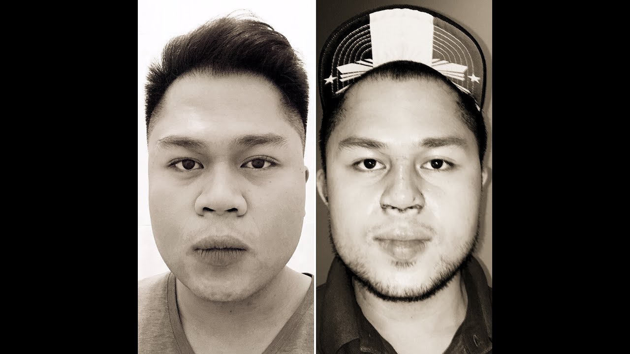 Male Rhinoplasty Vlog After Year Retoke Nose Lift Dr 1280x720 Male Rhinoplasty Vlog After Year Retoke Nose Lift Dr
