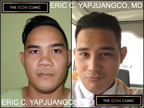 Nose Job, Nose Lift Or Rhinoplasty 480x360 Nose Job, Nose Lift Or Rhinoplasty