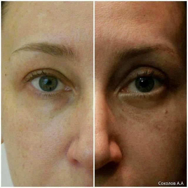 Blepharoplasty At The Icon Clinic Eyelid Surgery Cost, Photos 640x640 Blepharoplasty At The Icon Clinic Eyelid Surgery Cost, Photos