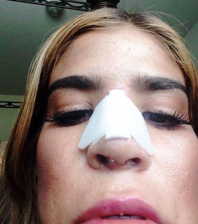 Philippines Nose Job Procedure At The Icon Clinic May Also Improve 400x452 Philippines Nose Job Procedure At The Icon Clinic May Also Improve