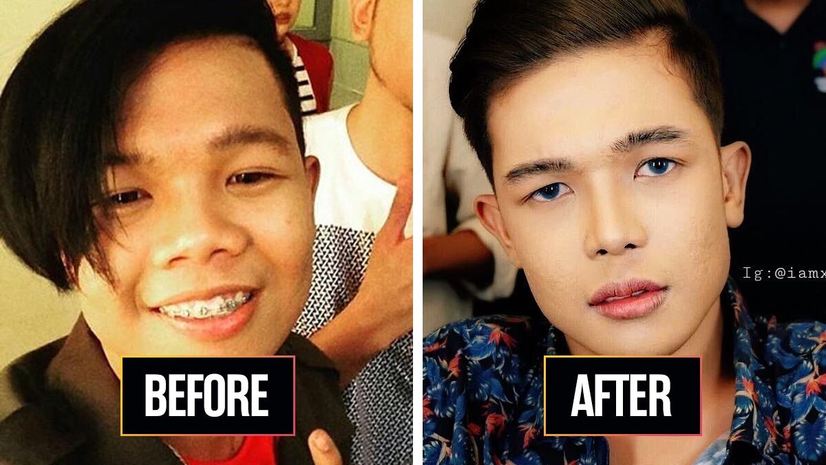 Rhinoplasty Philippines Doctors 1200x675 Rhinoplasty Philippines Doctors