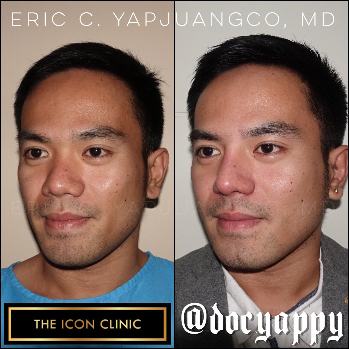 Eric Yapjuangco, Md On Twitter Months Post Surgery 1200x1200 Eric Yapjuangco, Md On Twitter Months Post Surgery