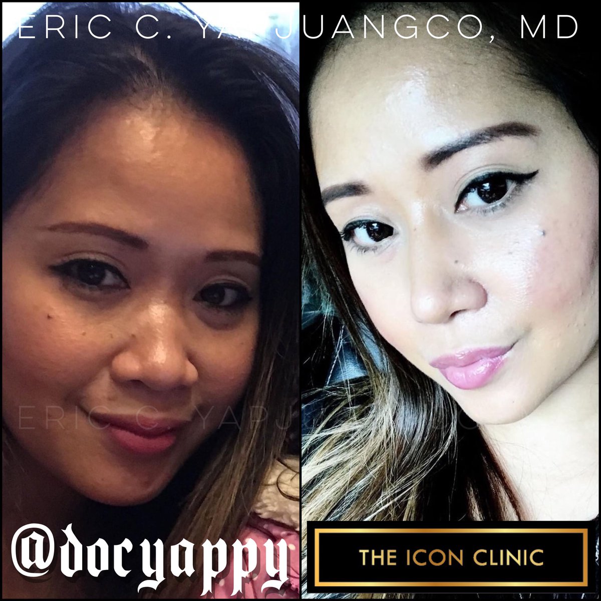 Eric Yapjuangco, Md On Twitter Months Post Surgery 1200x1200 Eric Yapjuangco, Md On Twitter Months Post Surgery