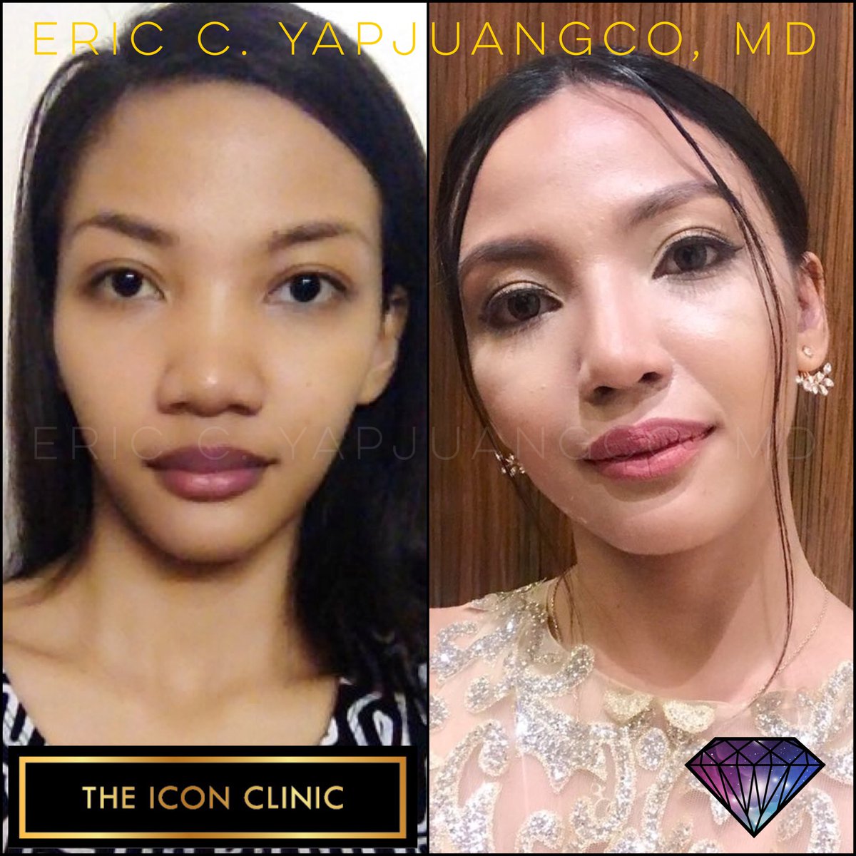 Eric Yapjuangco, Md On Twitter Weeks Post Surgery 1200x1200 Eric Yapjuangco, Md On Twitter Weeks Post Surgery