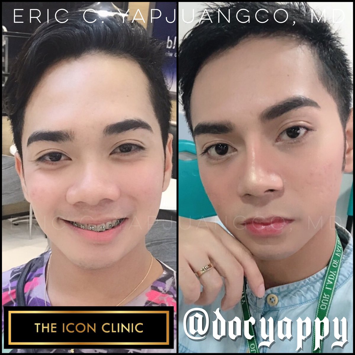Eric Yapjuangco, Md On Twitter Months Post Surgery 1200x1200 Eric Yapjuangco, Md On Twitter Months Post Surgery