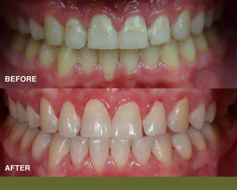 1000x803 Icon Resin Infiltration Peterson And Sunde Dentistry Bellevue