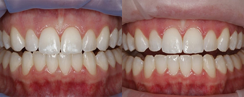 500x200 Icon Treatment White Spot Correction Advanced Services