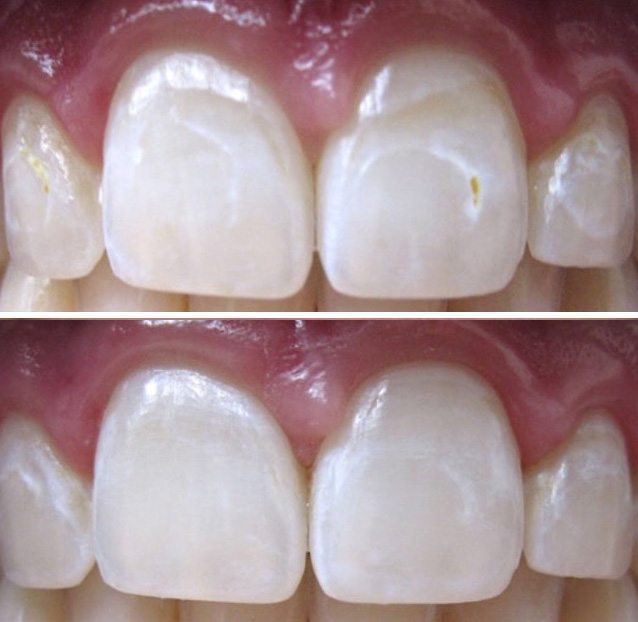 638x622 Caries Treatment Dentist In Muscatine, Ia