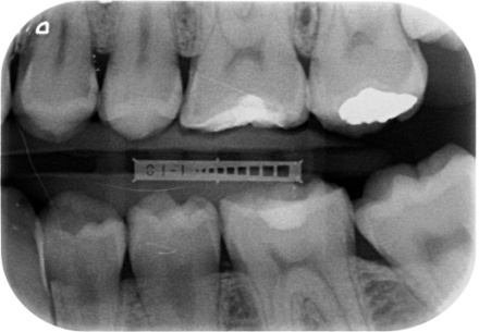 440x305 Digital X Ray After Icon Application