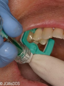 225x300 Treating Tooth Cavities Without The Drill Yes We Can! Julie M