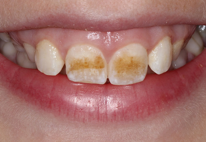 Icon Dental Treatment