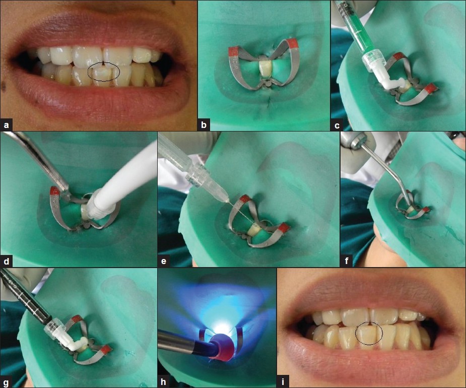 925x770 Icon Caries Infiltrant Smile Stylers Blog