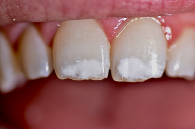 380x252 Icon Treatment