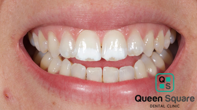 400x224 Icon White Spot Treatment Case Gallery