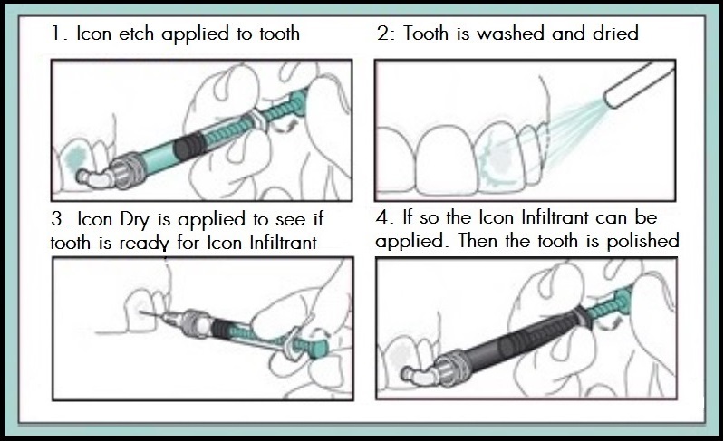 799x487 Icon Treatment Ashford Dental