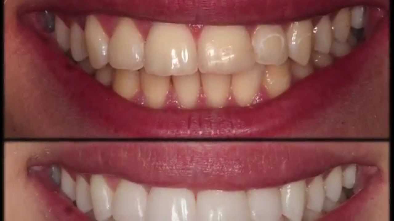 1280x720 Smile Improvement Tooth Whitening, Dmg Icon And Cosmetic