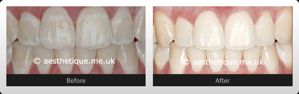 612x194 Stain Removal Leeds Cosmetic Dentist Leeds Invisalign