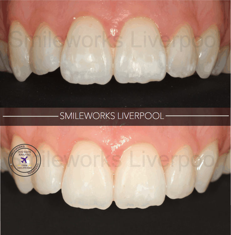 738x749 White Marks On Teeth How To Remove Them Price, Review Pictures