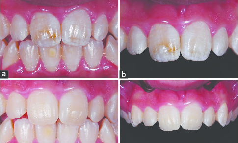485x292 A And B Pt Before Treatment