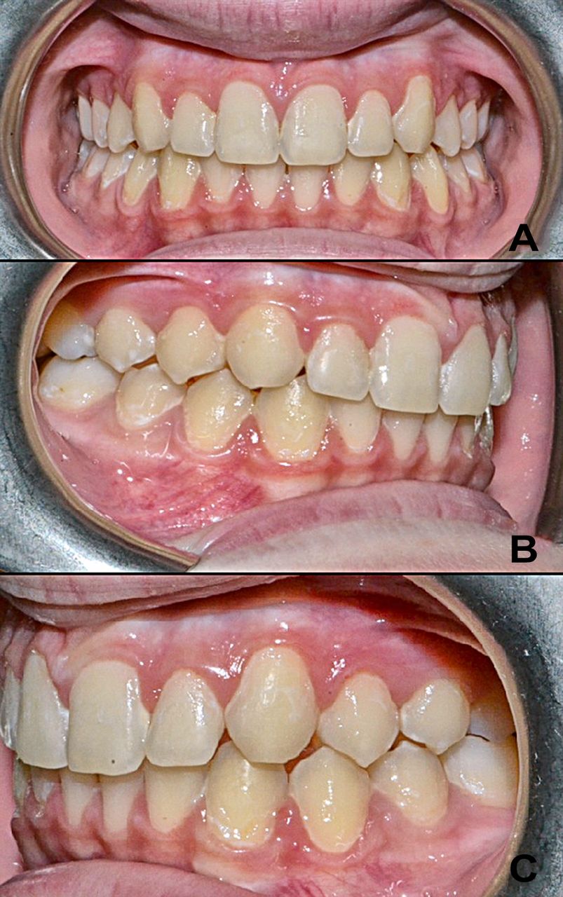 803x1280 Efficacy Of Year Treatment Of Icon Infiltration Resin
