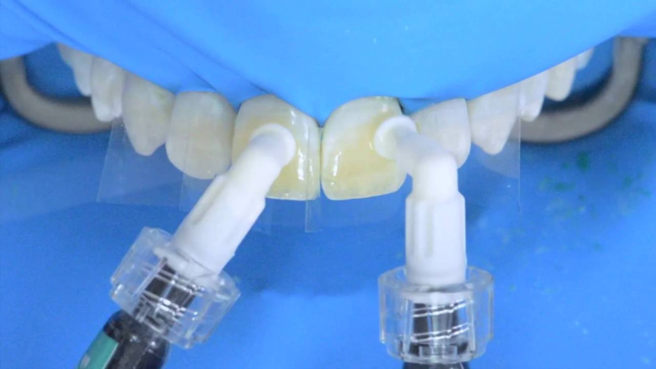 1280x720 Fluorosis Treatment Using Icon Infiltration, Step