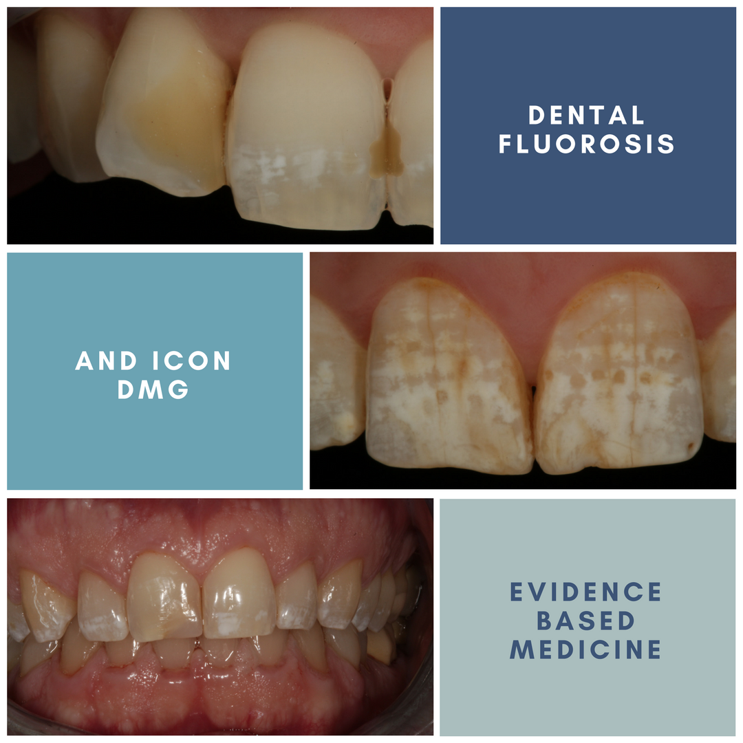 1080x1080 Fluorosis And Icon Dmg Cases And Scientific Evidence